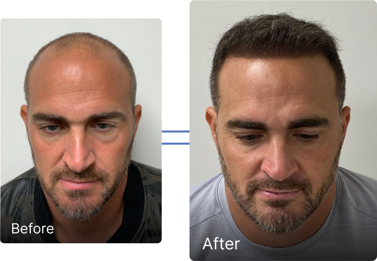 Before and after hair restoration
